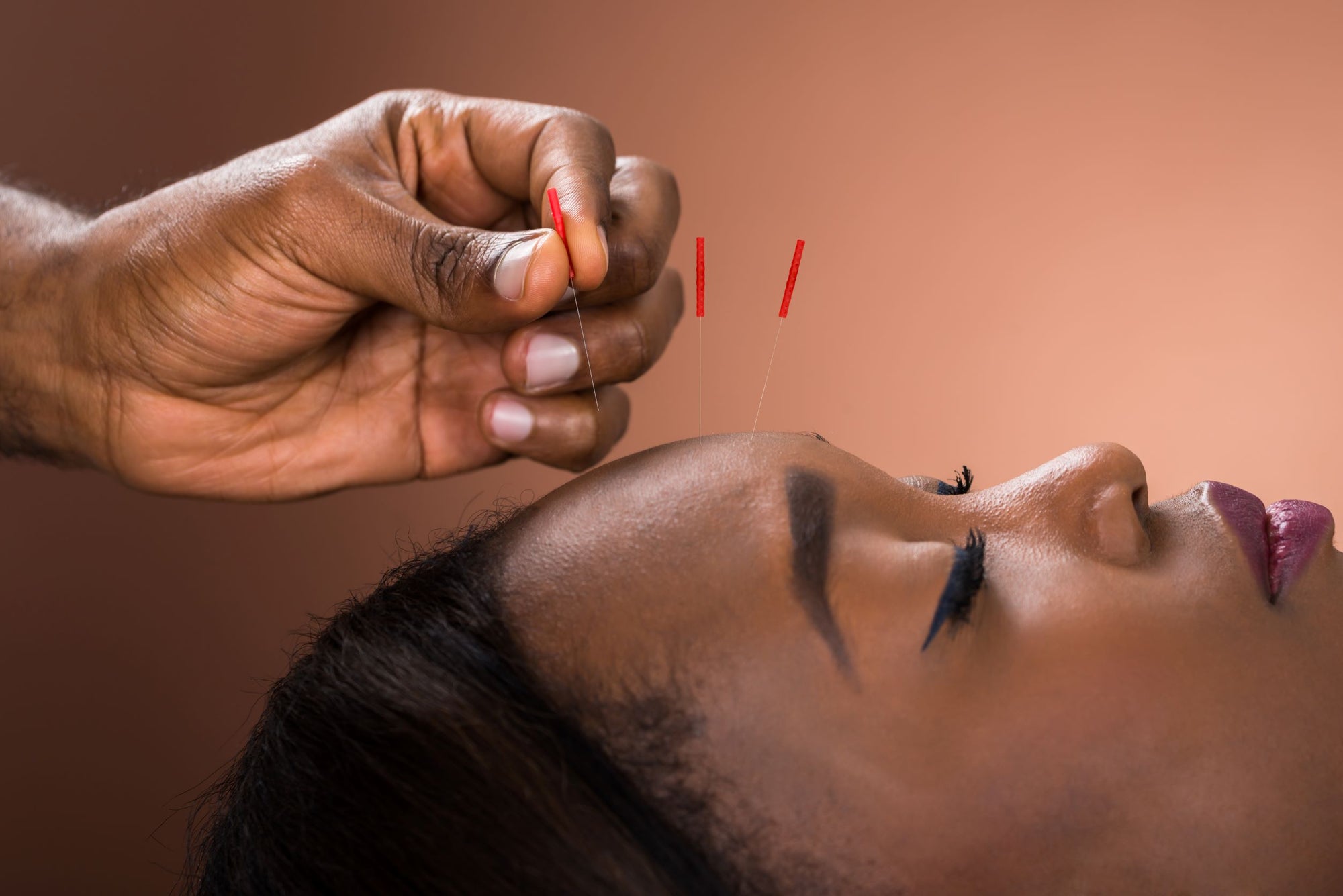 Acupuncture Your Way To Health